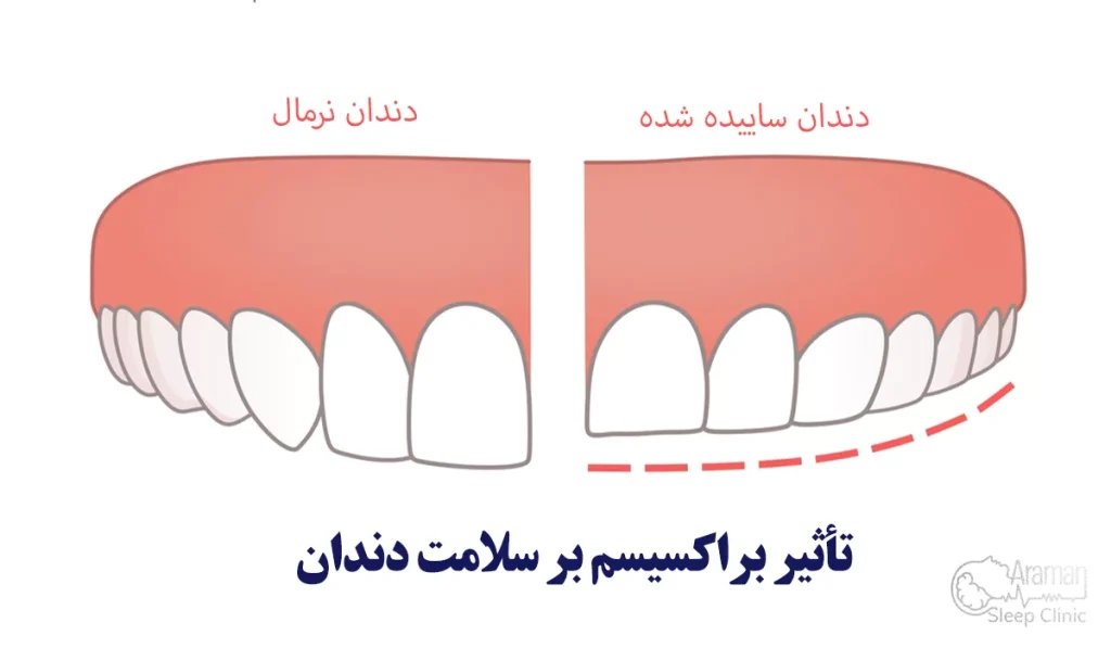 تأثیر دندان قروچه بر دندان ها