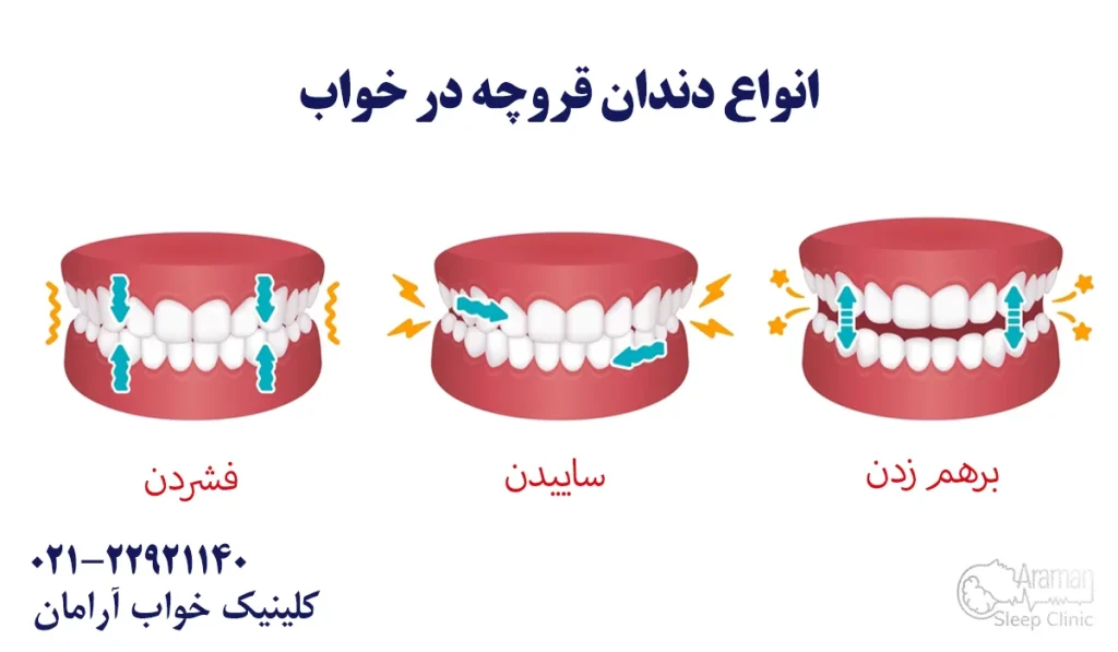 انواع دندان قروچه