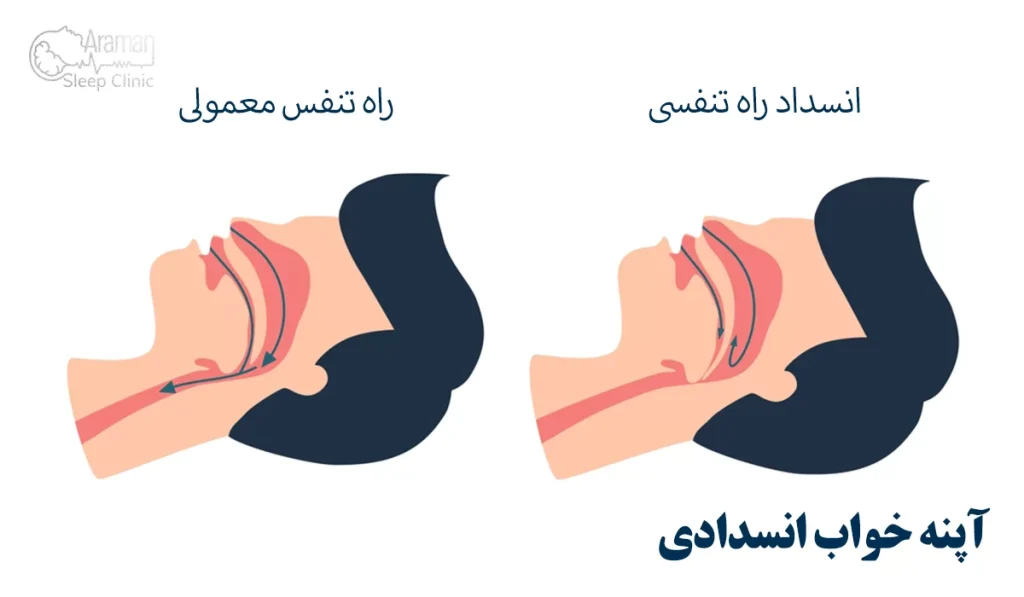 انواع وقفه تنفسی خواب