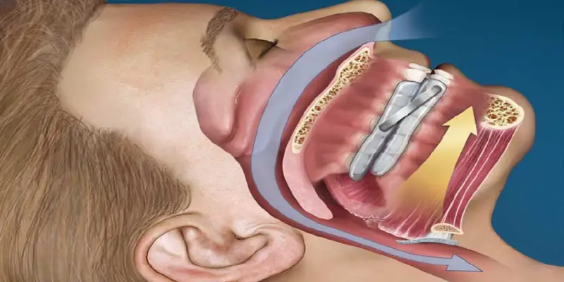 نحوه اندازه_گیری شاخص آپنه هیپوینه (AHI)