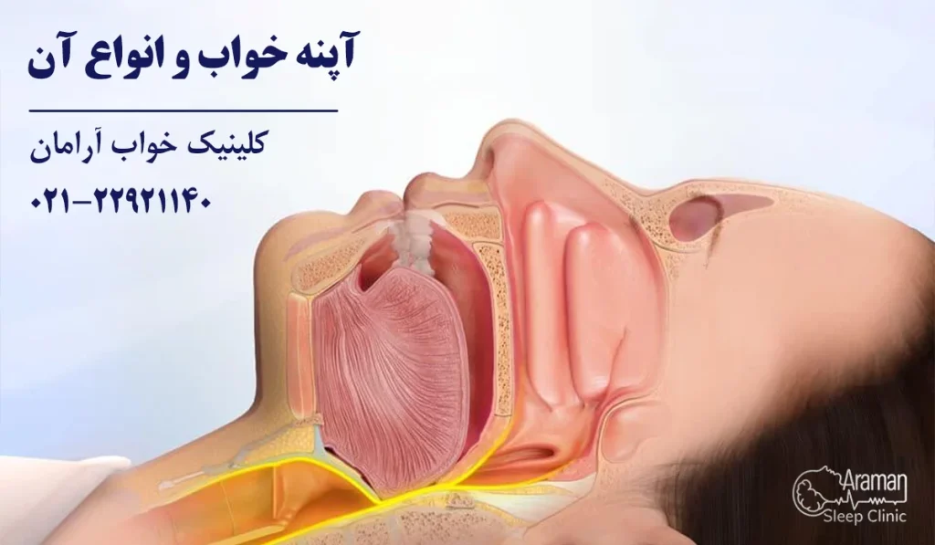 آپنه خواب و انواع آن