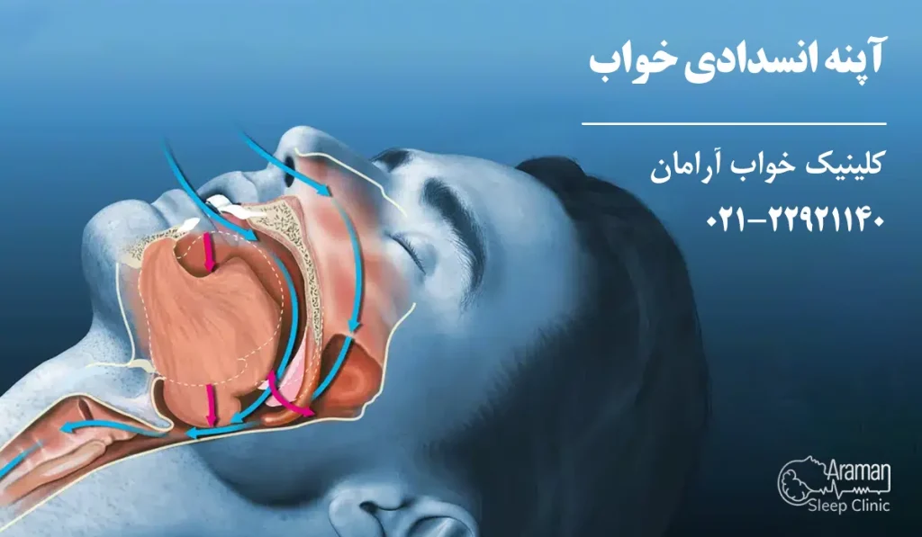 آپنه انسدادی خواب