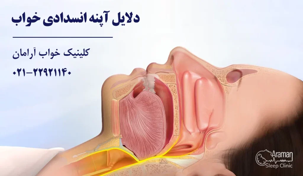 دلایل آپنه انسدادی خواب
