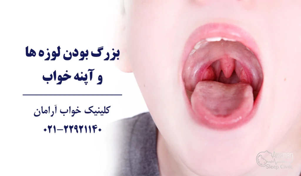 آپنه خواب در کودکان و لوزه